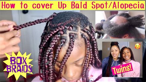 Update: How To cover Up Bald Spot/Alopecia/Box Braids/PROGRESS - YouTube