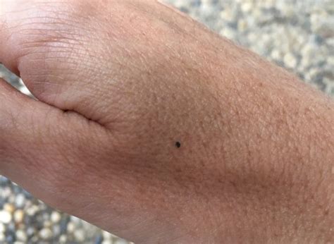 What you need to know about Blacklegged Ticks and Lyme Disease | Outdoor Herbivore Blog