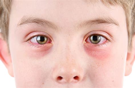 Allergic Conjunctivitis Vs Bacterial Conjunctivitis