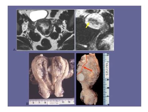 Images of a 55-year-old woman with superficial myometrial invasion. A ...