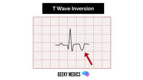 How to Read an ECG | ECG Interpretation | EKG | Geeky Medics