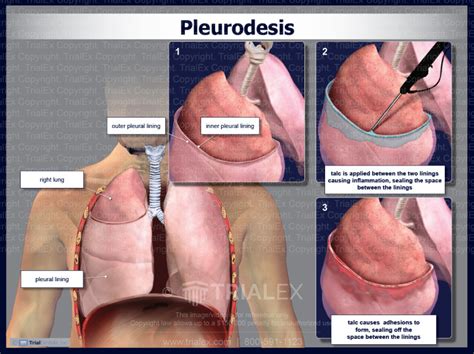 Pleurodesis - TrialExhibits Inc.