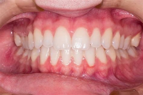 Do Orthodontic Braces Cause White Spots on Patients' Teeth?