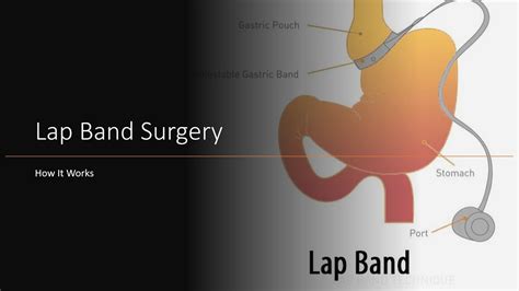 Lap Band Surgery - How It Works? - YouTube