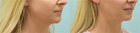 Dallas Botox Jaw Reduction Before and After Photos - Plano Plastic ...