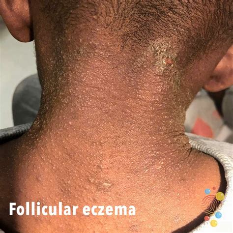 Eczema On Neck