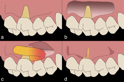 The Reverse Palatal Pedicle Graft for Maxillary Molar Palatal Recessions: Two Case Reports ...