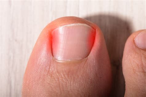 When Should You Go to the Doctor for an Ingrown Toenail? - MVS Podiatry Associates