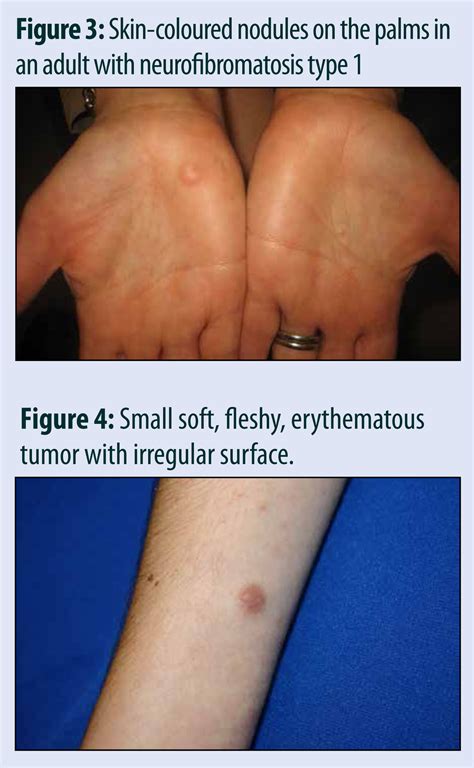 Cutaneous Features of Neurofibromatosis | healthPlexus.net