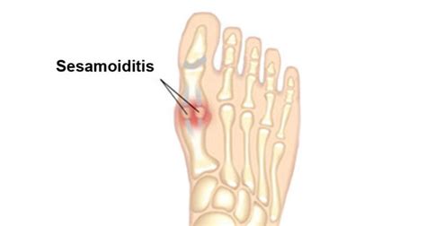 Sesamoiditis - Symptoms, Causes, Treatment & Surgery