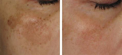 Pigmentation | Before & After | Kingsway Dermatology