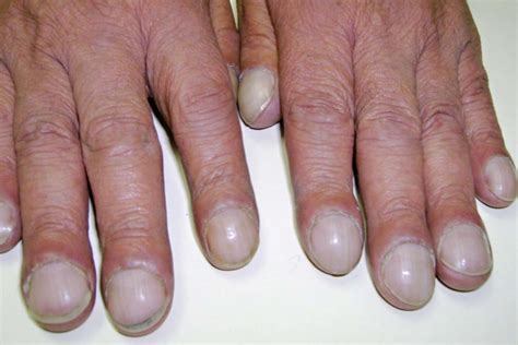 Finger Clubbing: Symptoms, Causes, Diagnosis, and Treatment