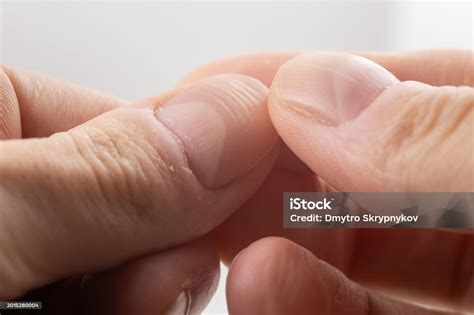 Ridged Fingernails With Vertical And Horizontal Ridges Nails Problems Stock Photo - Download ...