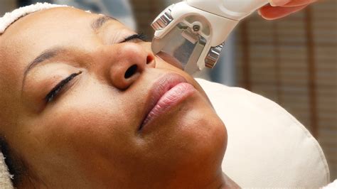 The Best Laser Treatments for Dark Skin | Allure