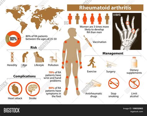 Rheumatoid Arthritis Vector & Photo (Free Trial) | Bigstock