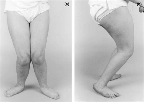 Figure 4 from Classification of gait patterns in spastic hemiplegia and ...