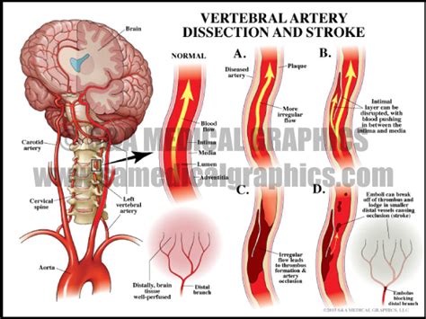 Neurosurgical Complications - S&A Medical Graphics