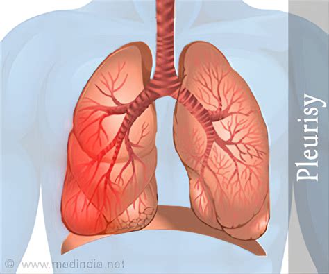 How To Detect Pleurisy - Respectprint22