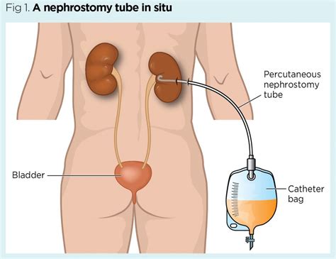 Nephrostomy Stoma