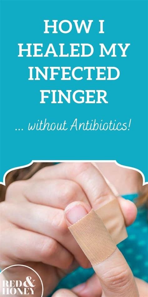 How I Healed My Infected Finger without Antibiotics - Red and Honey