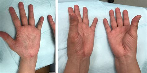 Carpal tunnel syndrome with thenar muscle atrophy: Camitz procedure ...