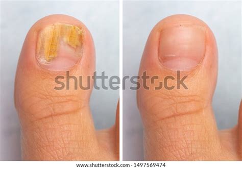 5,946 Fungal Nail Images, Stock Photos & Vectors | Shutterstock