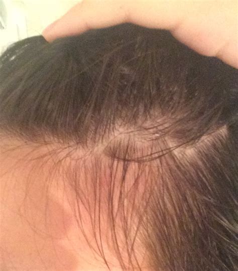 The Scary Reality Of Telogen Effluvium: Why You’re Losing Your Hair | Justinboey