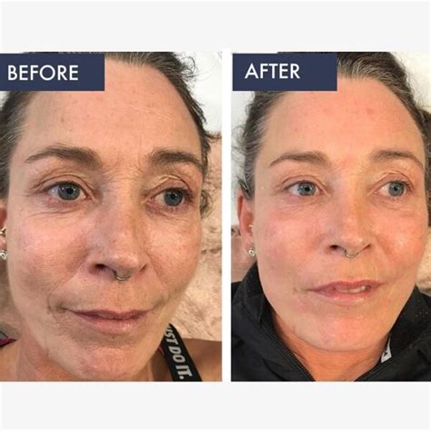 Retinol Before and After: Transform Your Skin with These Results - Must ...