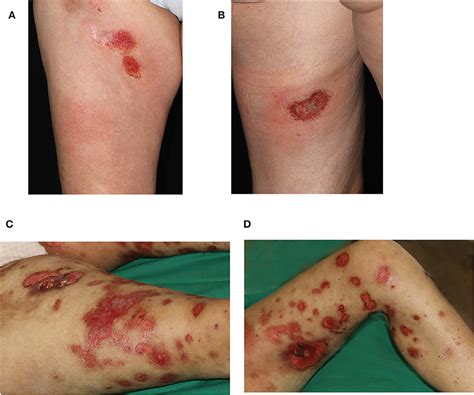 Frontiers | Primary Cutaneous Gamma-Delta T-Cell Lymphoma With Long-Term Indolent Clinical ...