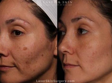 Laser Melasma Treatment New York, NY | Laser Center