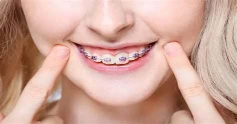 Fake Braces: What Are They and Why Are They Popular? - Dentaly.org