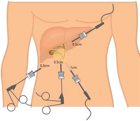 Laparoscopic Cholecystectomy