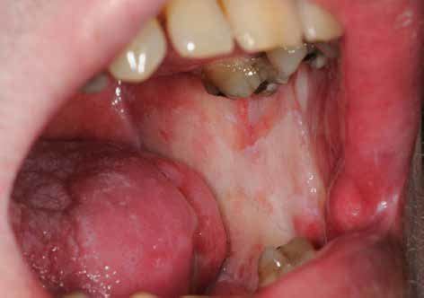 Oral Cancer Buccal Mucosa