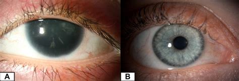 Aniridia: for patients - Gene Vision