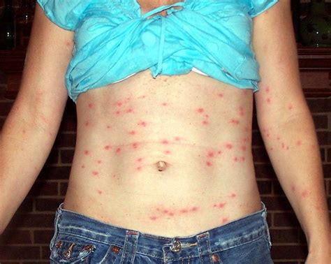 Chiggers (Mite) Bites, Rash Pictures, Treatment, Eradication | Healthhype.com