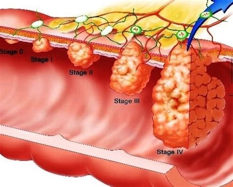 stages of colon cancer | Anatomy System - Human Body Anatomy diagram ...