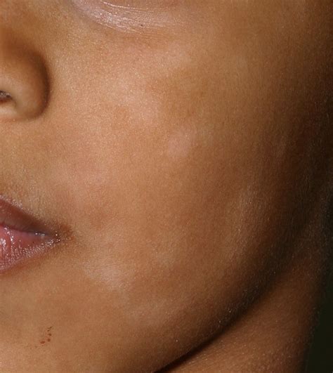 An approach to hypopigmentation | The BMJ