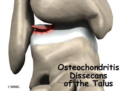 Osteochondritis Dissecans of the Talus - Orthopedic Surgery, Algonquin, IL, Barrington, IL ...