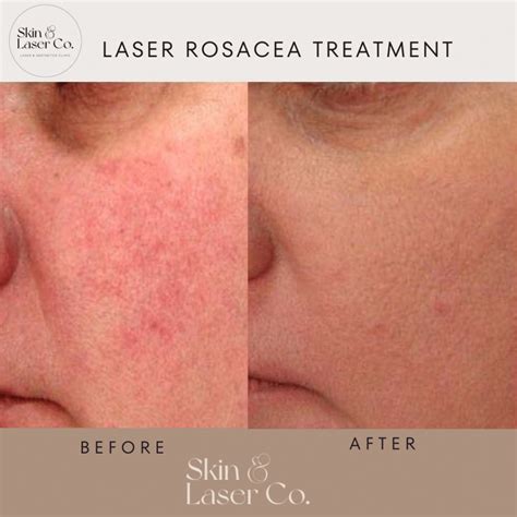 Laser Treatment for Rosacea - Skin Laser Co