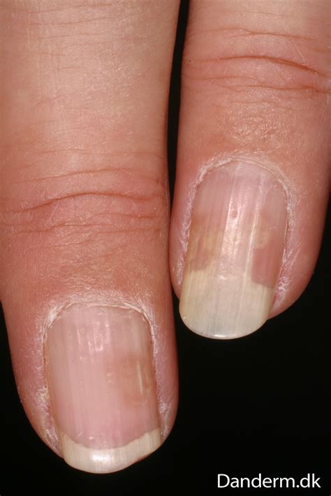 4-74-4 Psoriasis of the nails