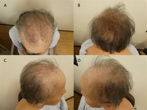 Minoxidil-responsive alopecia following treatment of a breast cancer ...