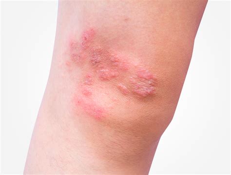 Dermatitis Herpetiformis | Celiac Disease Foundation