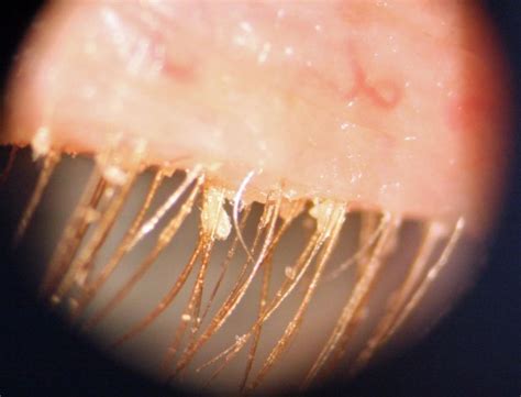 25 Best Demodex Causes - Demodectic Mange