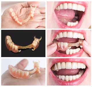 Partial Dentures Tucson Az - Taking Care of a Partial Denture