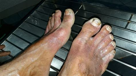 Plaque Psoriasis On Bottom Of Foot Factory Sale | emergencydentistry.com