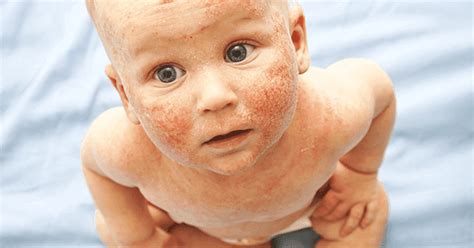 Eczema in Babies - Causes, Prevention and Treatment