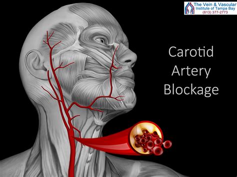 The majority of people with carotid artery blockage experience no symptoms. In rare cases ...