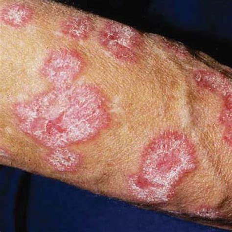 Skin Lupus (Cutaneous Lupus) | University of Utah Health