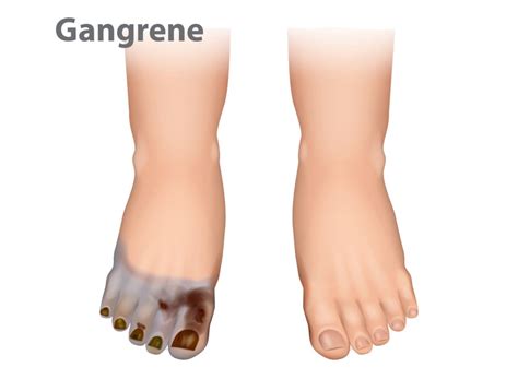 Gangrene -Types, Causes and Symptoms - Apollo Hospital Blog