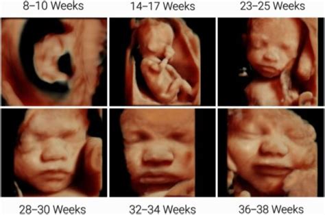 3D Ultrasound. - radiologystar